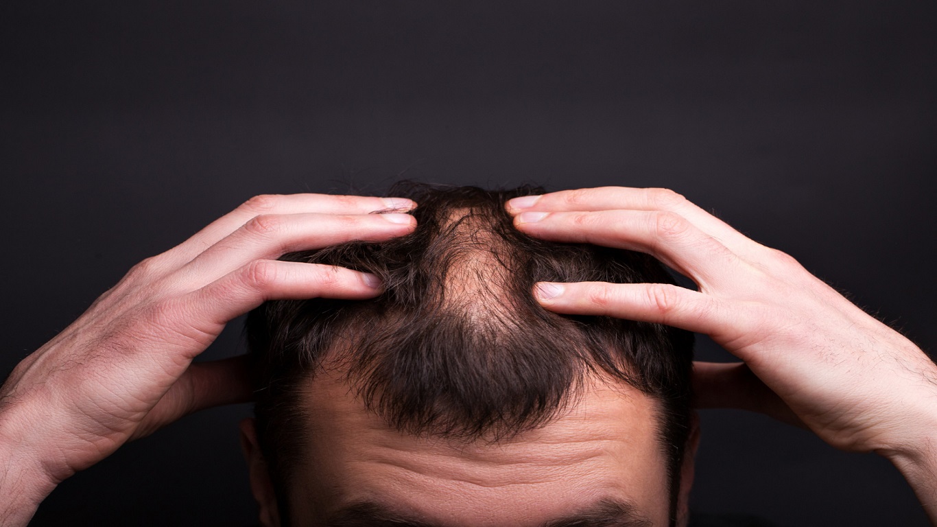 Does Testosterone Boosters Reduce Hair Loss